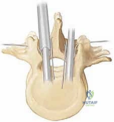 تثبيت نهايات القضيب في الحوض