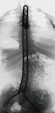 صورة توضيحية لـ جراحة الجنف العصبي العضلي بقضيب الوحدة: حل شامل لتحسين جودة الحياة للأطفال مع الأستاذ الدكتور محمد هطيف في صنعاء