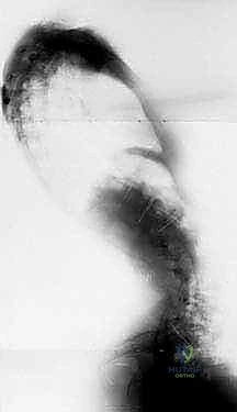 صورة طبية: جراحة الجنف العصبي العضلي بقضيب الوحدة: حل شامل لتحسين جودة الحياة للأطفال مع الأستاذ الدكتور محمد هطيف في صنعاء