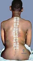 صورة طبية: جراحة الجنف العصبي العضلي بقضيب الوحدة: حل شامل لتحسين جودة الحياة للأطفال مع الأستاذ الدكتور محمد هطيف في صنعاء