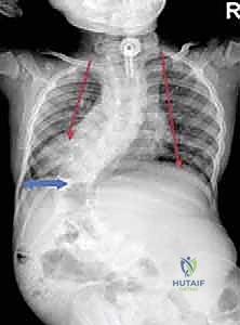 تأثير انحناء العمود الفقري على القفص الصدري