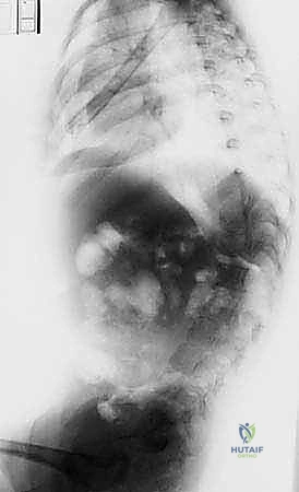 صورة توضيحية لـ علاج جنف الأطفال المبكر بقضبان النمو