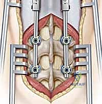 التحضير الجراحي لعملية قضبان النمو