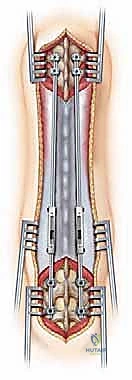 تثبيت الدعامات العلوية والسفلية