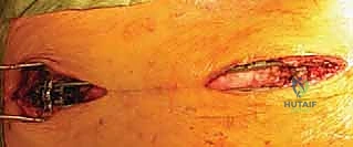 صورة توضيحية لـ علاج جنف الأطفال المبكر بقضبان النمو: دليل شامل للآباء مع الأستاذ الدكتور محمد هطيف