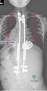 Illustration of growing rod instrumentation - Dr. Mohammed Hutaif