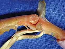 Masterclass: Precision Reconstruction of Boutonnière and Swan-Neck Deformities