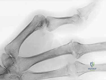 التصوير الشعاعي لمفاصل اليد