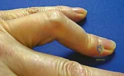 إصلاح الصفيحة الراحية في تشوه عنق البجعة