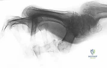 شكل تشوه عنق البجعة الميكانيكي