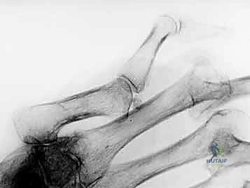 التخطيط الجراحي الدقيق قبل العملية