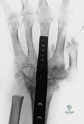 صورة توضيحية لـ تشوه العروة وتشوه عنق البجعة في اليد: دليل شامل للعلاج وإعادة التأهيل مع الأستاذ الدكتور محمد هطيف