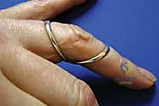 صورة توضيحية لـ تشوه العروة وتشوه عنق البجعة في اليد: دليل شامل للعلاج وإعادة التأهيل مع الأستاذ الدكتور محمد هطيف