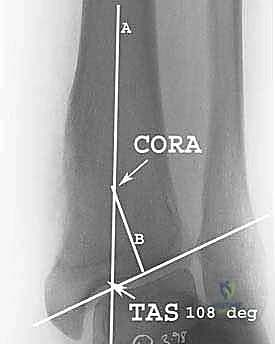 جراحة تقويم عظم الظنبوب فوق الكعب: حل متقدم للحفاظ على مفصل الكاحل وعلاج خشونة الكاحل مع الأستاذ الدكتور محمد هطيف