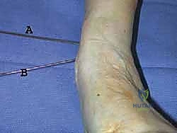 التشريح الدقيق لمنطقة الكاحل وعظم الظنبوب