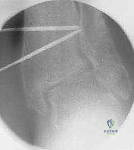 صورة توضيحية لـ جراحة تقويم عظم الظنبوب فوق الكعب: حل متقدم للحفاظ على مفصل الكاحل وعلاج خشونة الكاحل مع الأستاذ الدكتور محمد هطيف