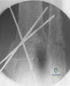 صورة توضيحية لـ جراحة تقويم عظم الظنبوب فوق الكعب: حل متقدم للحفاظ على مفصل الكاحل وعلاج خشونة الكاحل مع الأستاذ الدكتور محمد هطيف