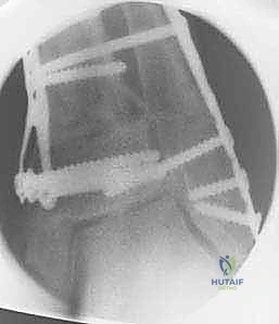 إجراء القطع العظمي بدقة متناهية