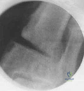 مرحلة التعافي والعلاج الطبيعي بعد الجراحة