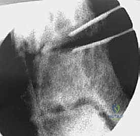 تثبيت العظم باستخدام الشرائح والمسامير الطبية