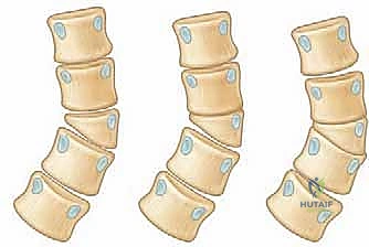 صورة توضيحية لـ استئصال الفقرة النصفية وإعادة بناء العمود الفقري
