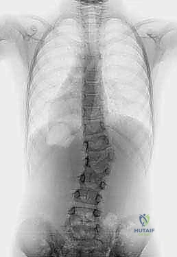 توضيح شكل الفقرة النصفية وتأثيرها على العمود الفقري