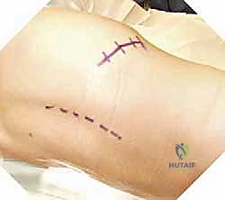 صورة أشعة سينية تبين التخطيط قبل الجراحة