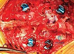 تحديد الموقع والشق الجراحي