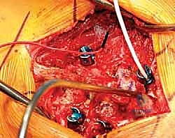 كشف العضلات والوصول للعمود الفقري