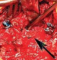 التأكد من مسار المسامير بالأشعة