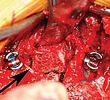 بدء استئصال الفقرة النصفية