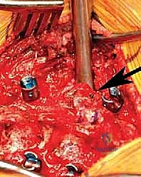 إدخال مسامير التثبيت بدقة