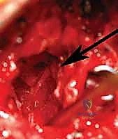 تنظيف مكان الفقرة النصفية بالكامل