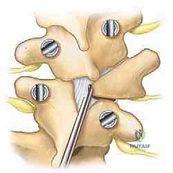 إزالة الأجزاء العظمية المشوهة