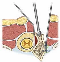 صورة توضح أنواع الفقرات النصفية المختلفة