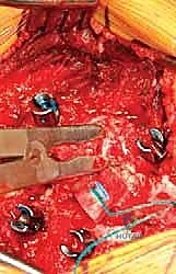 الوصول إلى الفراغ المطلوب بعد الاستئصال