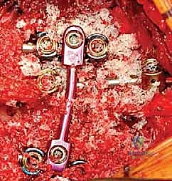 وضع القضيب المعدني للربط بين المسامير