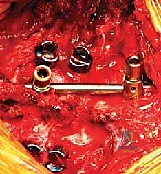 استئصال الفقرة النصفية وإعادة بناء العمود الفقري: دليل شامل لاستعادة استقامة العمود الفقري لدى الأطفال مع الأستاذ الدكتور محمد هطيف