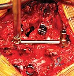 تطبيق الضغط لإغلاق الفراغ وتقويم العمود الفقري