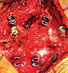 صورة توضيحية لـ استئصال الفقرة النصفية وإعادة بناء العمود الفقري: دليل شامل لاستعادة استقامة العمود الفقري لدى الأطفال مع الأستاذ الدكتور محمد هطيف