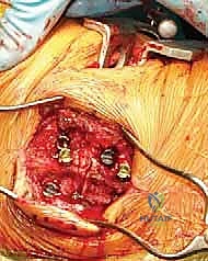 Intraoperative Surgical Step