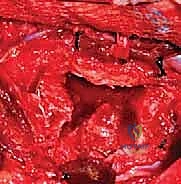 صورة توضيحية لـ استئصال الفقرة النصفية وإعادة بناء العمود الفقري: دليل شامل لاستعادة استقامة العمود الفقري لدى الأطفال مع الأستاذ الدكتور محمد هطيف