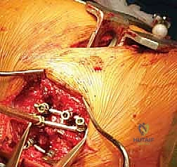 صورة توضيحية لـ استئصال الفقرة النصفية وإعادة بناء العمود الفقري: دليل شامل لاستعادة استقامة العمود الفقري لدى الأطفال مع الأستاذ الدكتور محمد هطيف