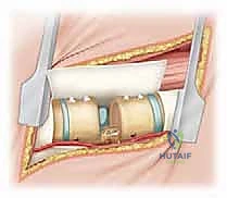 Illustration of hemivertebra excision hemivertebra - Dr. Mohammed Hutaif