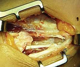 صورة توضيحية لـ علاج مرفق لاعب الغولف جراحياً: دليل شامل لتحرير التهاب اللقيمة الإنسية