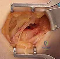 صورة توضيحية لـ علاج مرفق لاعب الغولف جراحياً: دليل شامل لتحرير التهاب اللقيمة الإنسية