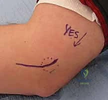 صورة توضيحية لـ علاج مرفق لاعب الغولف جراحياً: دليل شامل لتحرير التهاب اللقيمة الإنسية