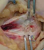 Medial Epicondylitis Release: An Intraoperative Masterclass in Flexor-Pronator Debridement and Ulnar Nerve Management