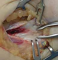 صورة توضيحية لـ علاج مرفق لاعب الغولف جراحياً: دليل شامل لتحرير التهاب اللقيمة الإنسية