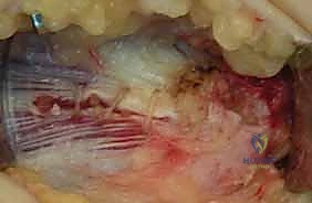 صورة توضيحية لـ علاج مرفق لاعب الغولف جراحياً: دليل شامل لتحرير التهاب اللقيمة الإنسية